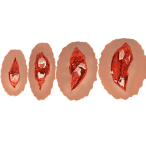 Adhesive Open Fracture Wound Moulage Kit